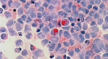 EUA aprovam tratamento revolucionário para o cancro do pâncreas