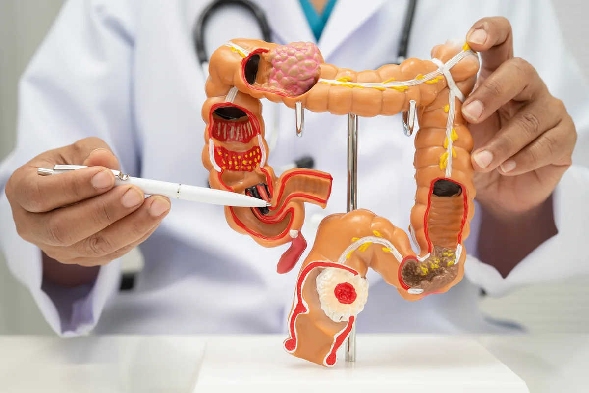 Câncer de intestino, excesso de peso e canetas emagrecedoras: o que a ciência nos mostra até aqui