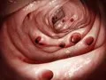 Divertículos: los alimentos que sí puedes comer y el mito de los frutos secos y las semillas