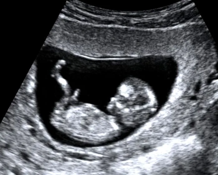 We terminated a pregnancy so our daughter never had to suffer. It was agony. It cannot be the right of One Nation – or any anti-abortion activist – to choose for us | Anonymous