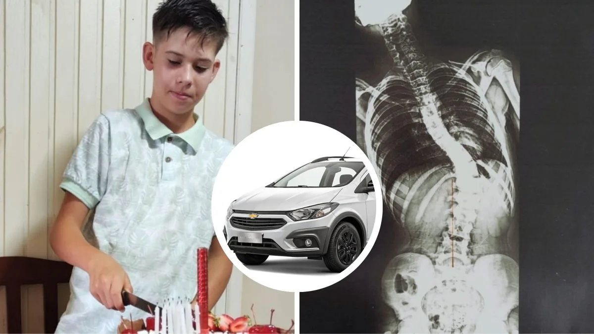 Família rifa o próprio carro para custear cirurgia de R$ 182 mil de adolescente com escoliose grave em SC