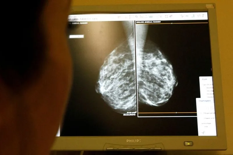 La IA podría detectar enfermedades cardiacas en mujeres mediante mamografías