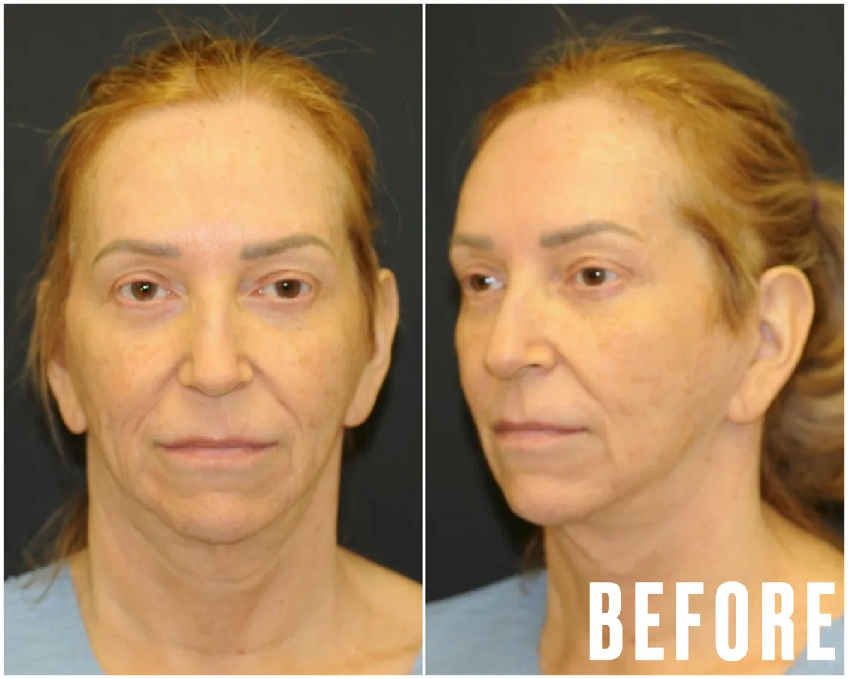 Woman Gets Life-Changing Surgery for Common GLP-1 Side Effect