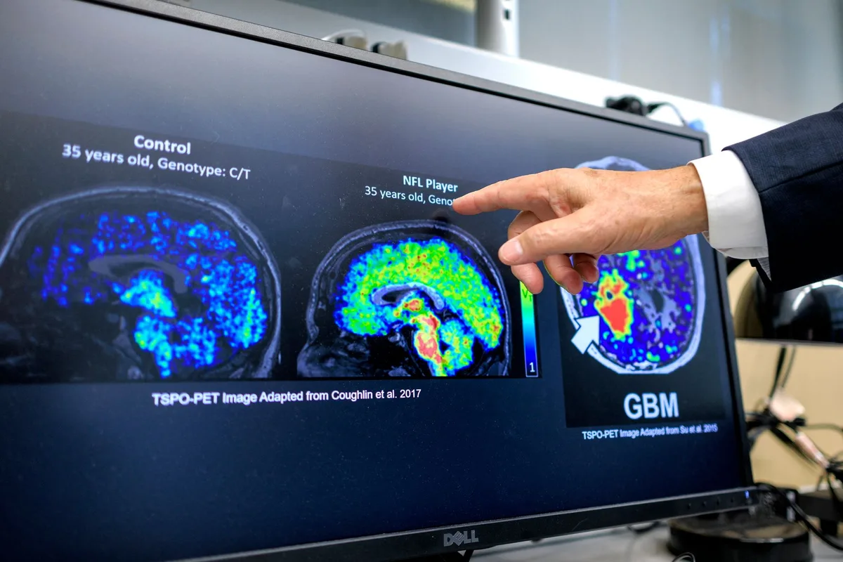 Alzheimer : « Le plus grand danger n’est plus seulement la maladie, mais aussi le retard du diagnostic »