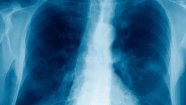 Lungenkrebs: »Die Lunge ist ein sehr geduldiges Organ«
