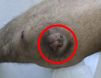 “1년째 안 낫더니 악취까지”… 3cm 종괴로 커진 다리 상처, 원인은 반려견?