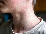 First measles deaths recorded of 2026... as cases reach highest level in more than three decades