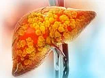 These are the tips I give to all my patients who want to heal their liver disease - with the right changes you can reverse the damage in months: DR PHILIPPA KAYE