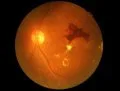 Un medicamento oral podría proteger la visión frente a la retinopatía diabética
